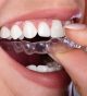 Invisalign clear aligners: A discreet alternative to braces