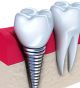 Customized replacement options for missing teeth