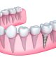 Are dental implants worth the cost?