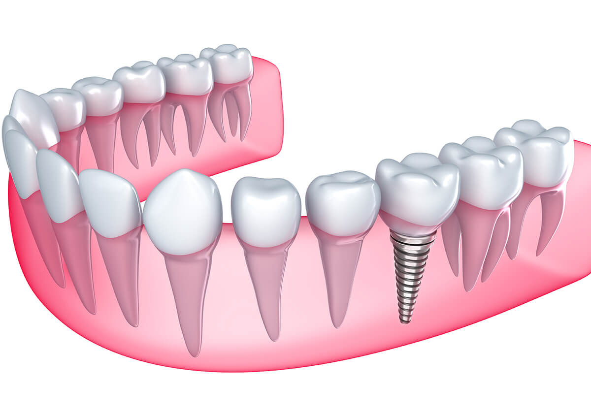 Dental Implants in San Antonio Texas Area