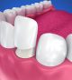Learn More About the Process of the Dental Veneers Procedure