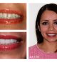 Where can I find a dentist for placing natural-looking porcelain veneers?